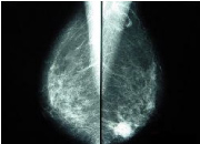 乳房X線装置(マンモグラフィ)