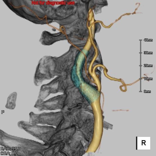 右内頚動脈ステント留置後　評価画像1
