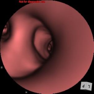 気管支仮想内視鏡画像8