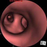 気管支仮想内視鏡画像9
