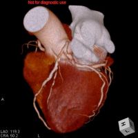 冠動脈CT（心臓CT）1