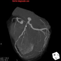 冠動脈CT（心臓CT）2