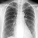 胸部X線画像