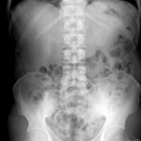 腹部X線画像