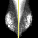 両側乳房X線画像